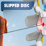 slipped-disc-treatment-kuala-lumpur