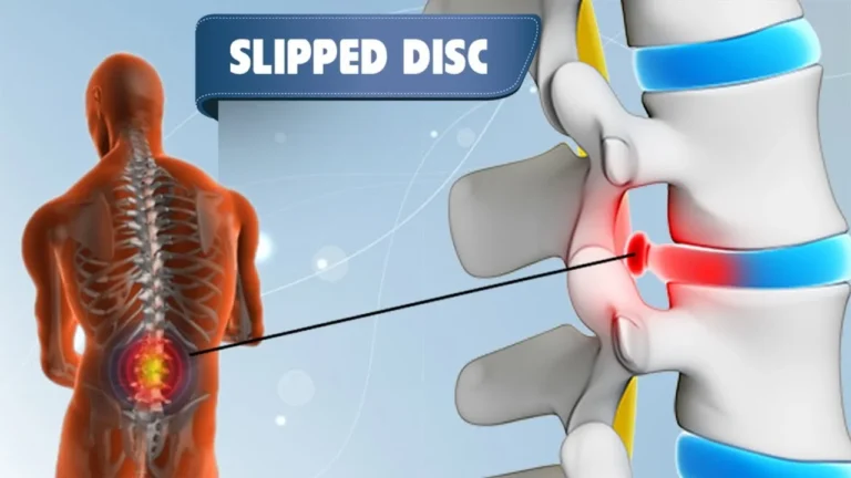 slipped-disc-treatment-kuala-lumpur