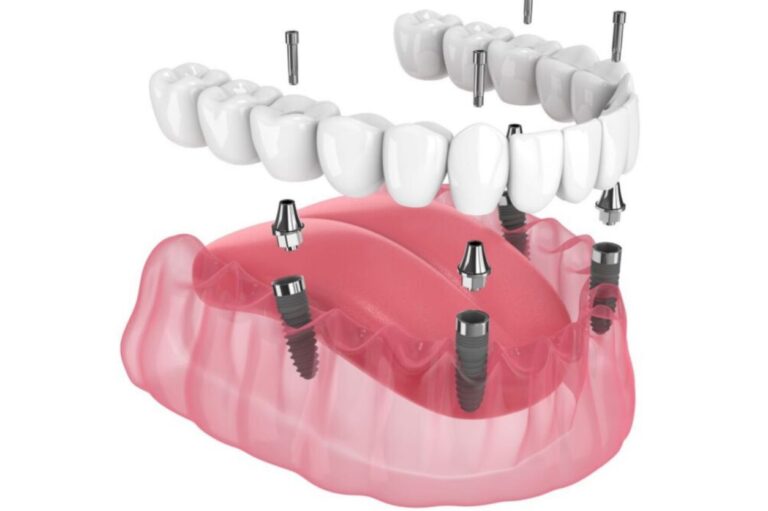 All-On-4 Dental Implants Everything You Need to Know